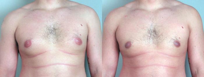 Gynecomastia Surgery Case 617 Before & After View #1 | Paramus, New Jersey | Parker Center for Plastic Surgery