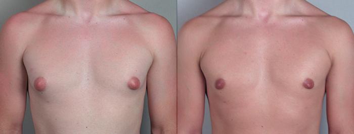 Gynecomastia Surgery Case 618 Before & After View #1 | Paramus, New Jersey | Parker Center for Plastic Surgery