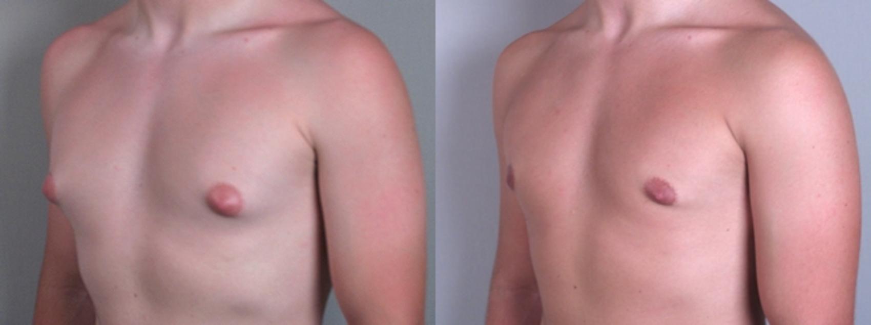 Gynecomastia Surgery Case 618 Before & After View #2 | Paramus, New Jersey | Parker Center for Plastic Surgery
