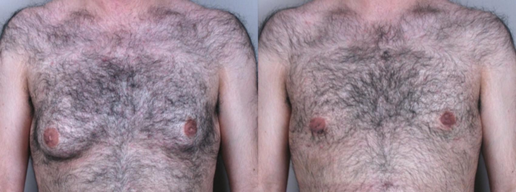 Gynecomastia Surgery Case 619 Before & After View #1 | Paramus, New Jersey | Parker Center for Plastic Surgery