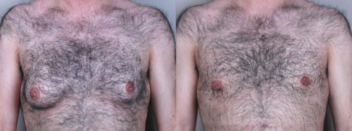 Gynecomastia Surgery Case 619 Before & After View #1 | Paramus, New Jersey | Parker Center for Plastic Surgery