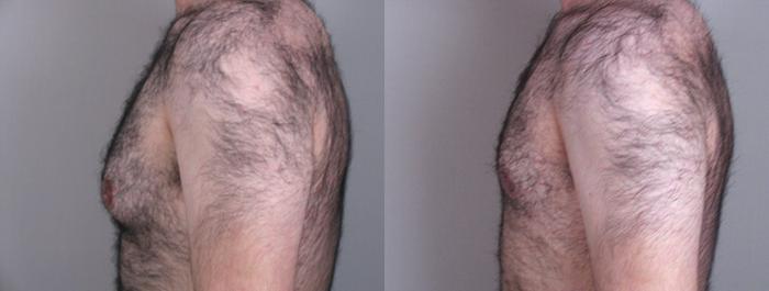 Gynecomastia Surgery Case 619 Before & After View #2 | Paramus, New Jersey | Parker Center for Plastic Surgery