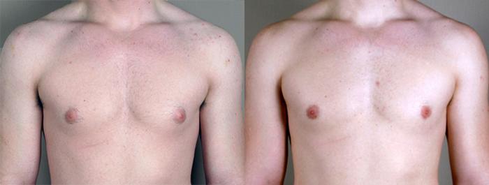 Gynecomastia Surgery Case 620 Before & After View #1 | Paramus, New Jersey | Parker Center for Plastic Surgery