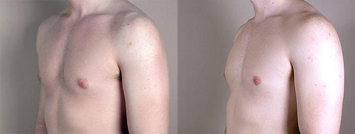 Gynecomastia Surgery Case 620 Before & After View #2 | Paramus, New Jersey | Parker Center for Plastic Surgery