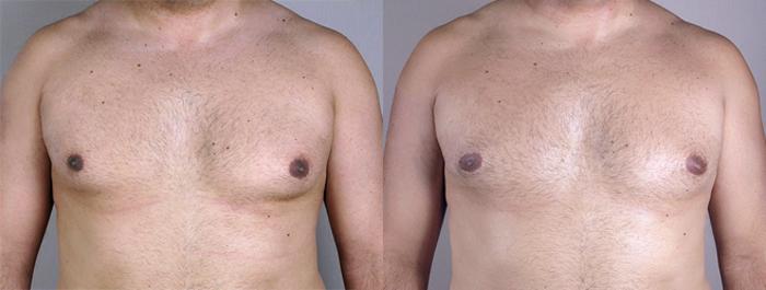 Gynecomastia Surgery Case 621 Before & After View #1 | Paramus, New Jersey | Parker Center for Plastic Surgery