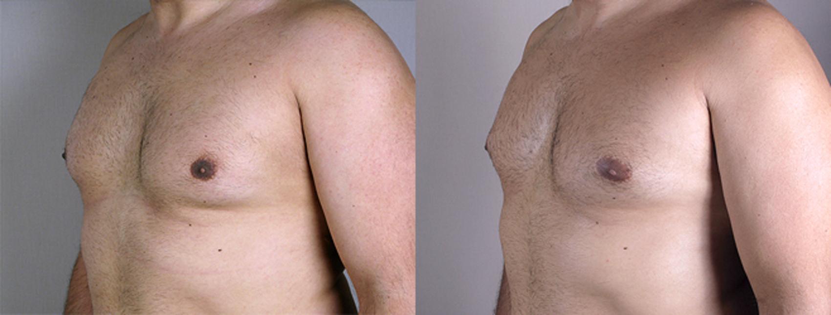 Gynecomastia Surgery Case 621 Before & After View #2 | Paramus, New Jersey | Parker Center for Plastic Surgery
