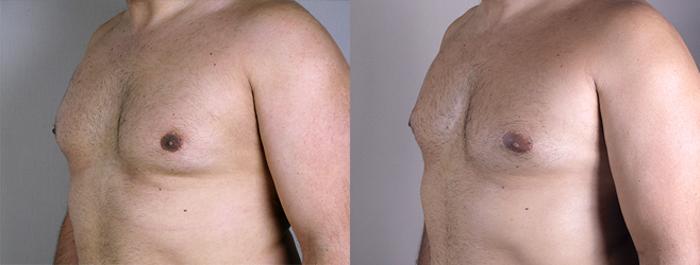 Gynecomastia Surgery Case 621 Before & After View #2 | Paramus, New Jersey | Parker Center for Plastic Surgery
