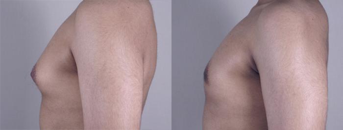 Gynecomastia Surgery Case 622 Before & After View #2 | Paramus, New Jersey | Parker Center for Plastic Surgery