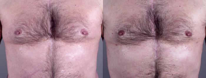 Gynecomastia Surgery Case 623 Before & After View #1 | Paramus, New Jersey | Parker Center for Plastic Surgery