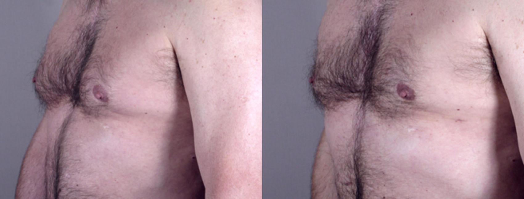 Gynecomastia Surgery Case 623 Before & After View #2 | Paramus, New Jersey | Parker Center for Plastic Surgery
