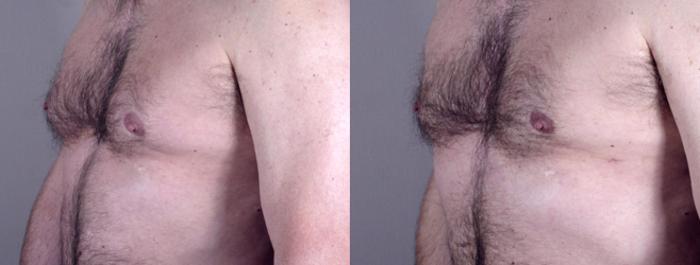 Gynecomastia Surgery Case 623 Before & After View #2 | Paramus, New Jersey | Parker Center for Plastic Surgery