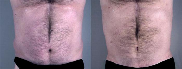 Gynecomastia Surgery Case 623 Before & After View #3 | Paramus, New Jersey | Parker Center for Plastic Surgery