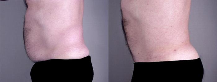 Gynecomastia Surgery Case 623 Before & After View #4 | Paramus, New Jersey | Parker Center for Plastic Surgery