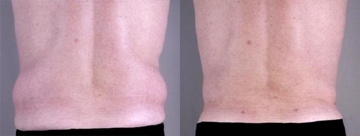 Gynecomastia Surgery Case 623 Before & After View #5 | Paramus, New Jersey | Parker Center for Plastic Surgery