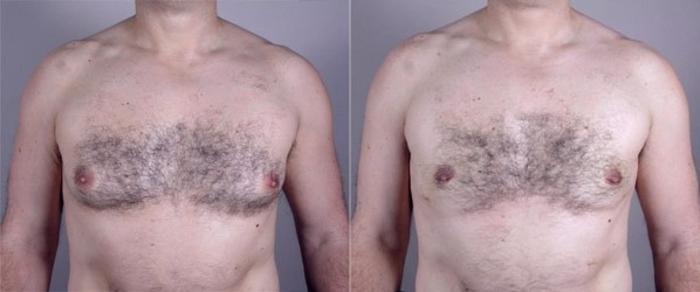 Gynecomastia Surgery Case 624 Before & After View #1 | Paramus, New Jersey | Parker Center for Plastic Surgery