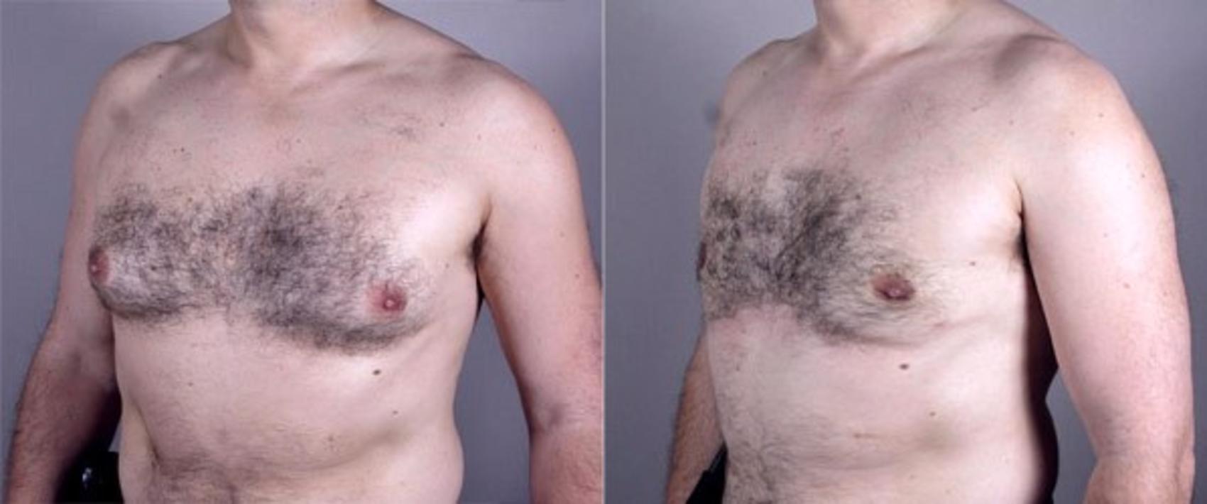 Gynecomastia Surgery Case 624 Before & After View #2 | Paramus, New Jersey | Parker Center for Plastic Surgery