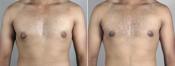 Gynecomastia Surgery Case 625 Before & After View #1 | Paramus, New Jersey | Parker Center for Plastic Surgery