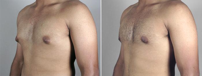 Gynecomastia Surgery Case 625 Before & After View #2 | Paramus, New Jersey | Parker Center for Plastic Surgery