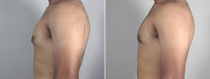 Gynecomastia Surgery Case 625 Before & After View #3 | Paramus, New Jersey | Parker Center for Plastic Surgery