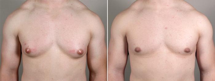 Gynecomastia Surgery Case 626 Before & After View #1 | Paramus, New Jersey | Parker Center for Plastic Surgery