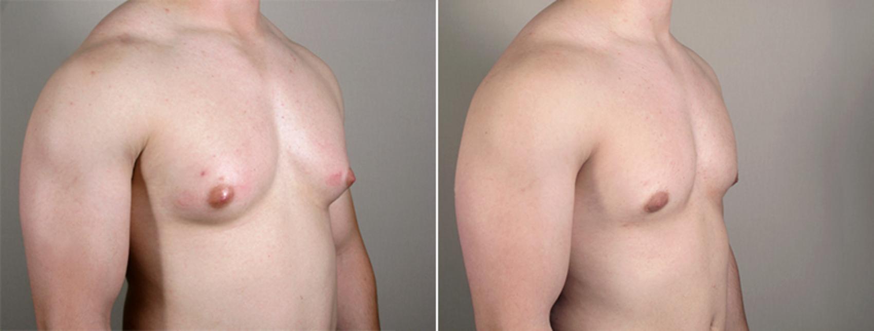 Gynecomastia Surgery Case 626 Before & After View #2 | Paramus, New Jersey | Parker Center for Plastic Surgery