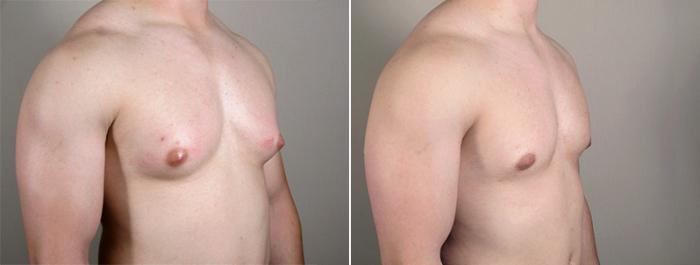 Gynecomastia Surgery Case 626 Before & After View #2 | Paramus, New Jersey | Parker Center for Plastic Surgery