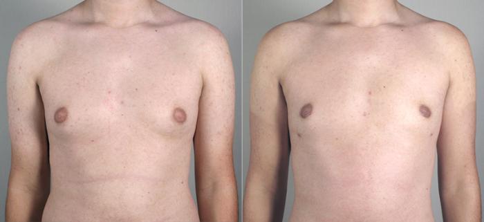 Gynecomastia Surgery Case 627 Before & After View #1 | Paramus, New Jersey | Parker Center for Plastic Surgery