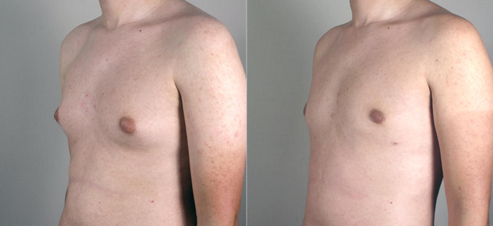 Gynecomastia Surgery Case 627 Before & After View #2 | Paramus, New Jersey | Parker Center for Plastic Surgery