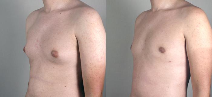 Gynecomastia Surgery Case 627 Before & After View #2 | Paramus, New Jersey | Parker Center for Plastic Surgery