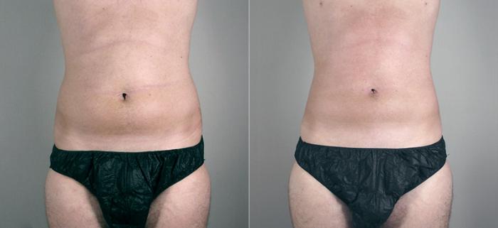 Gynecomastia Surgery Case 627 Before & After View #3 | Paramus, New Jersey | Parker Center for Plastic Surgery