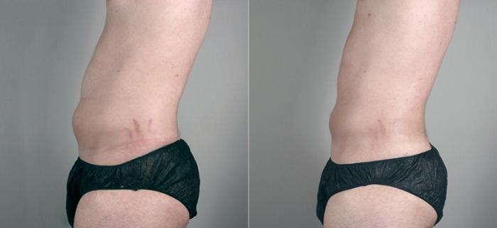 Gynecomastia Surgery Case 627 Before & After View #4 | Paramus, New Jersey | Parker Center for Plastic Surgery