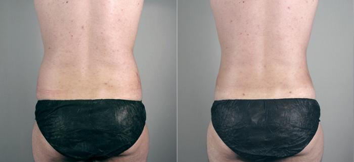 Gynecomastia Surgery Case 627 Before & After View #5 | Paramus, New Jersey | Parker Center for Plastic Surgery