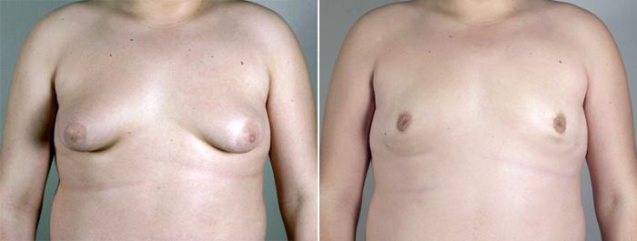 Gynecomastia Surgery Case 628 Before & After View #1 | Paramus, New Jersey | Parker Center for Plastic Surgery