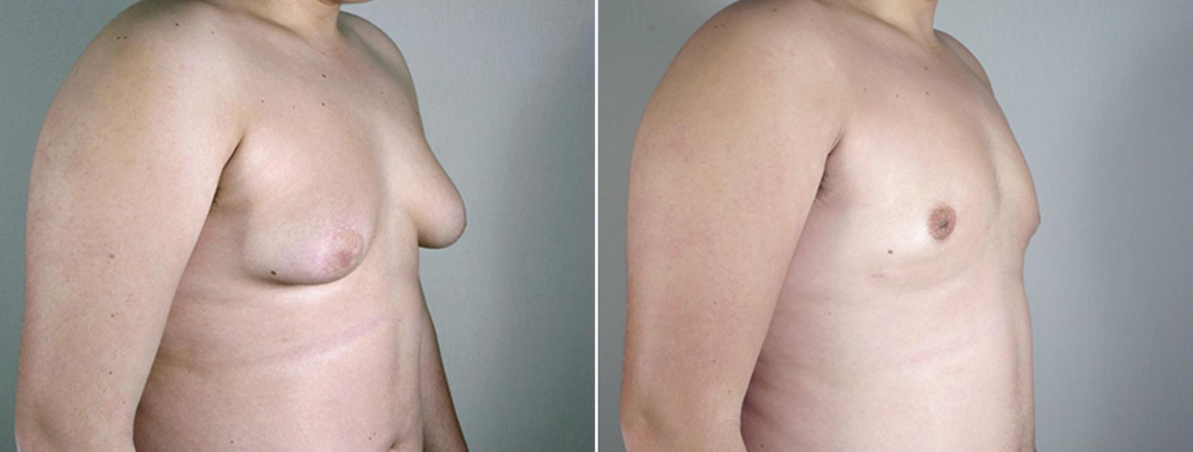 Gynecomastia Surgery Case 628 Before & After View #2 | Paramus, New Jersey | Parker Center for Plastic Surgery