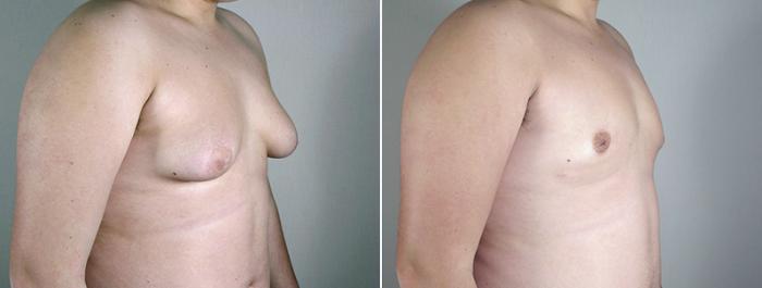 Gynecomastia Surgery Case 628 Before & After View #2 | Paramus, New Jersey | Parker Center for Plastic Surgery