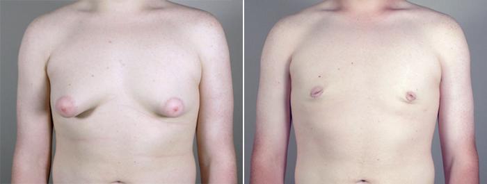 Gynecomastia Surgery Case 630 Before & After View #1 | Paramus, New Jersey | Parker Center for Plastic Surgery