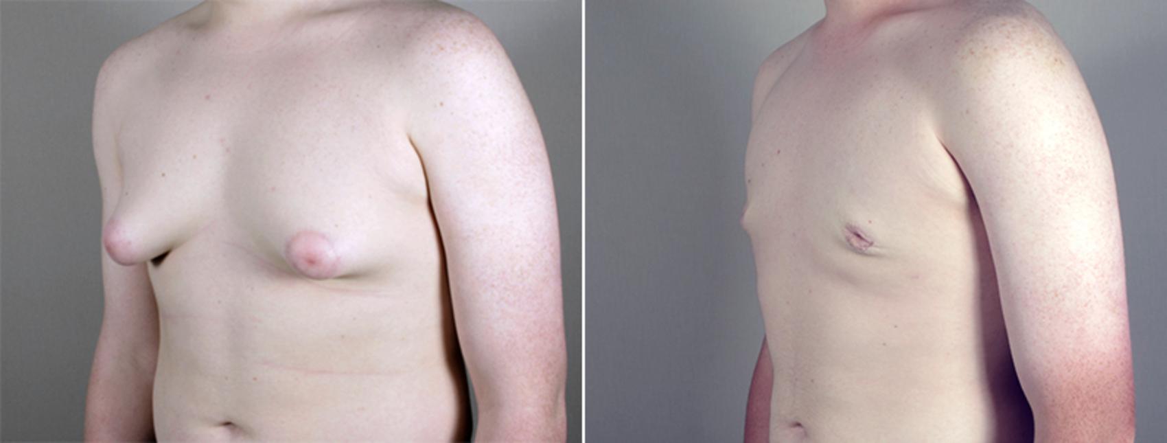 Gynecomastia Surgery Case 630 Before & After View #2 | Paramus, New Jersey | Parker Center for Plastic Surgery