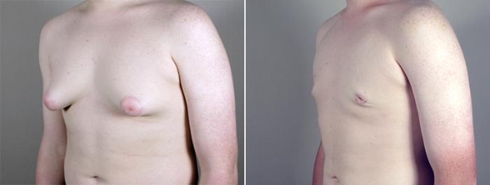Gynecomastia Surgery Case 630 Before & After View #2 | Paramus, New Jersey | Parker Center for Plastic Surgery