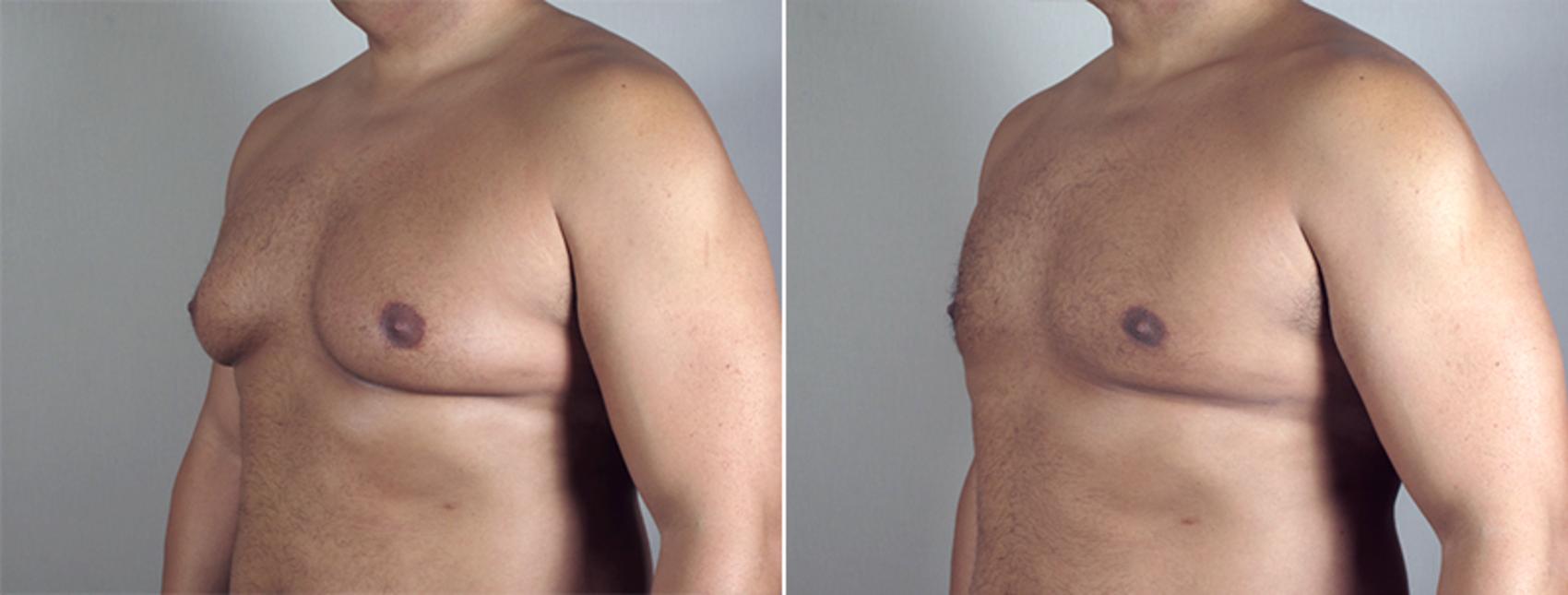 Gynecomastia Surgery Case 631 Before & After View #1 | Paramus, New Jersey | Parker Center for Plastic Surgery
