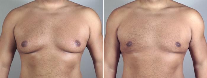 Gynecomastia Surgery Case 631 Before & After View #2 | Paramus, New Jersey | Parker Center for Plastic Surgery