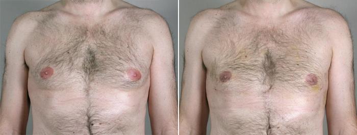 Gynecomastia Surgery Case 632 Before & After View #1 | Paramus, New Jersey | Parker Center for Plastic Surgery