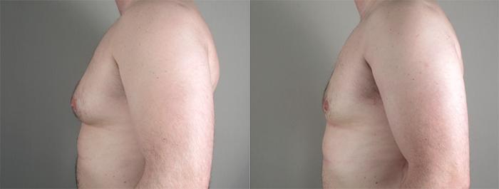 Gynecomastia Surgery Case 633 Before & After View #2 | Paramus, New Jersey | Parker Center for Plastic Surgery