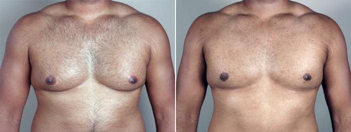 Gynecomastia Surgery Case 634 Before & After View #1 | Paramus, New Jersey | Parker Center for Plastic Surgery