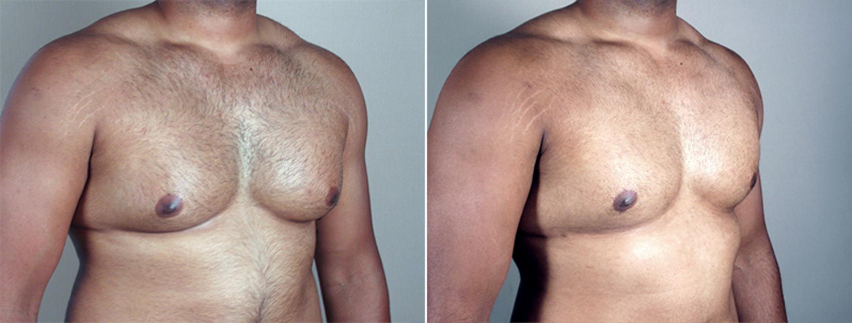 Gynecomastia Surgery Case 634 Before & After View #2 | Paramus, New Jersey | Parker Center for Plastic Surgery