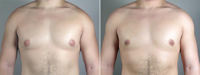 Gynecomastia Surgery Case 635 Before & After View #1 | Paramus, New Jersey | Parker Center for Plastic Surgery
