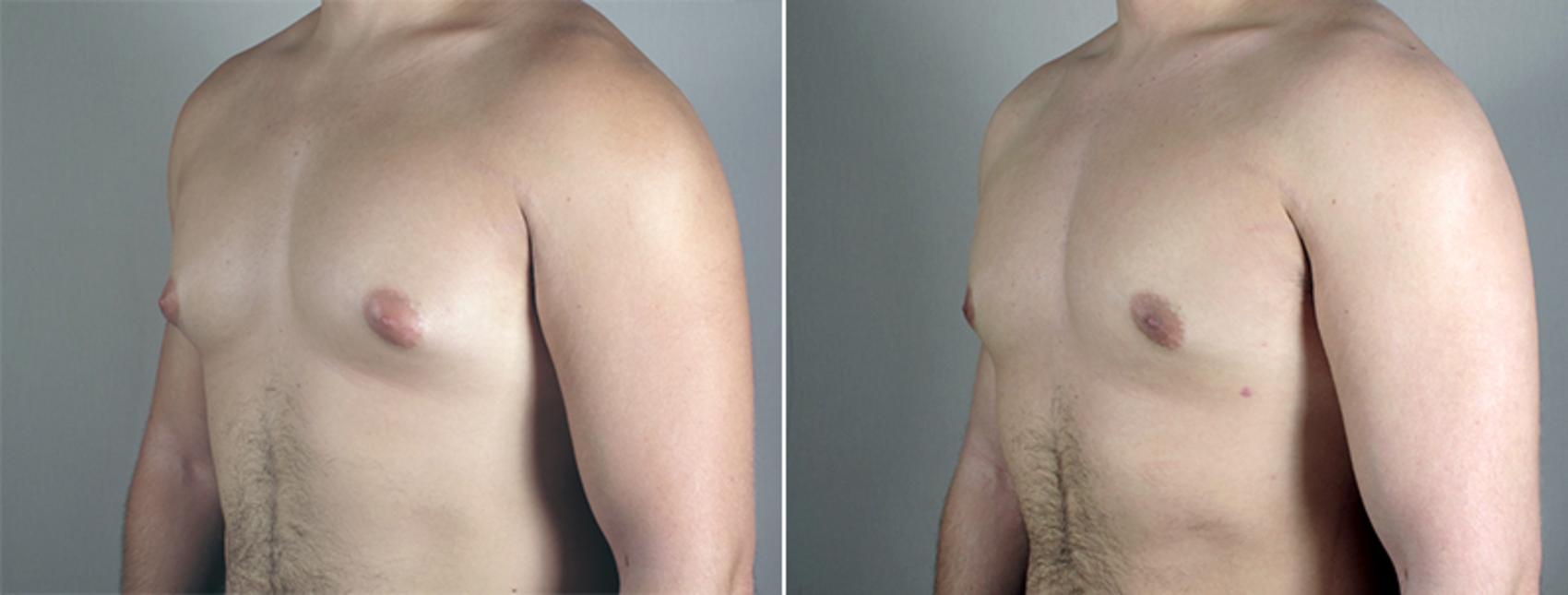 Gynecomastia Surgery Case 635 Before & After View #2 | Paramus, New Jersey | Parker Center for Plastic Surgery