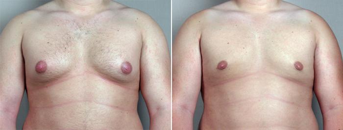 Gynecomastia Surgery Case 636 Before & After View #1 | Paramus, New Jersey | Parker Center for Plastic Surgery
