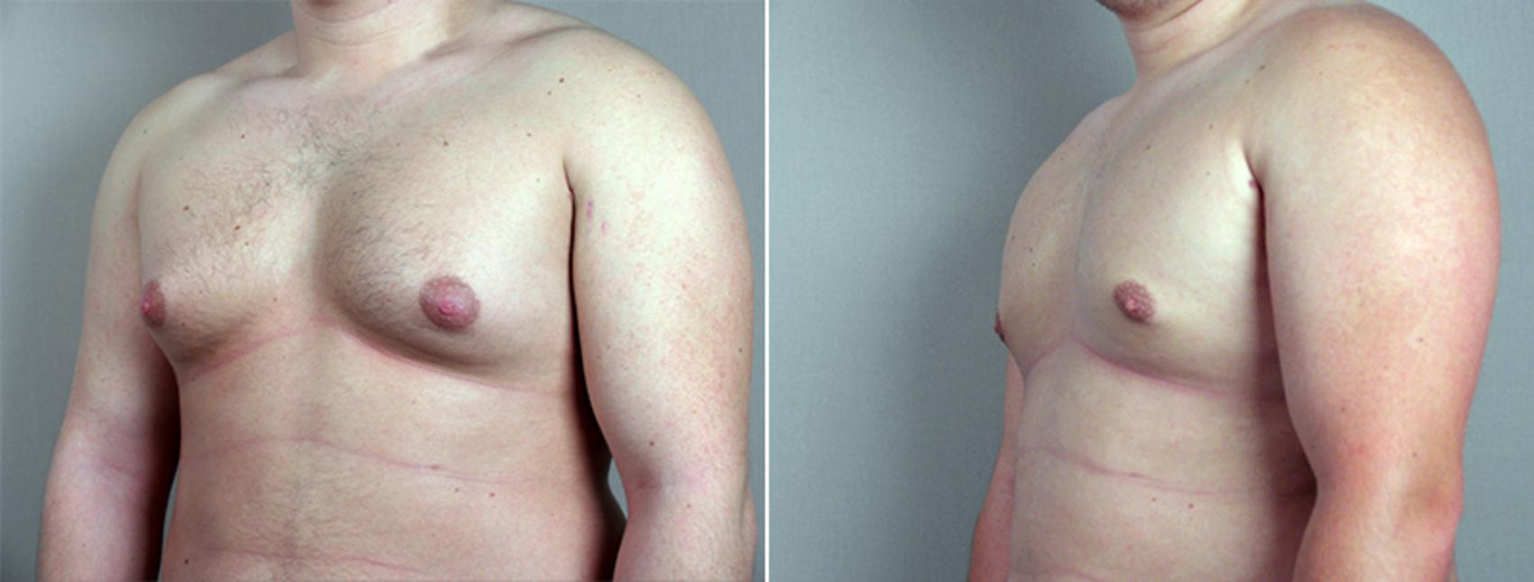 Gynecomastia Surgery Case 636 Before & After View #2 | Paramus, New Jersey | Parker Center for Plastic Surgery