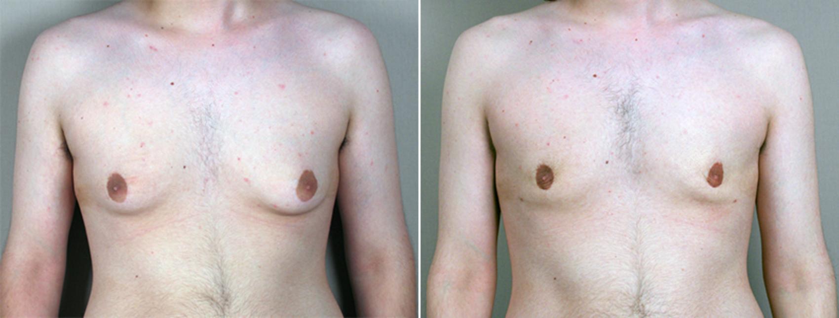 Gynecomastia Surgery Case 637 Before & After View #1 | Paramus, New Jersey | Parker Center for Plastic Surgery