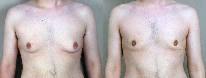 Gynecomastia Surgery Case 637 Before & After View #1 | Paramus, New Jersey | Parker Center for Plastic Surgery